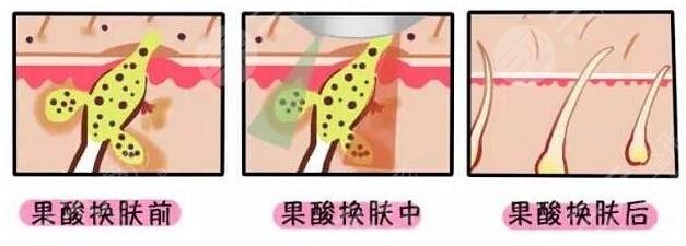 做果酸美肤的注意事项