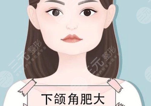 下颌角宽大怎么改善？