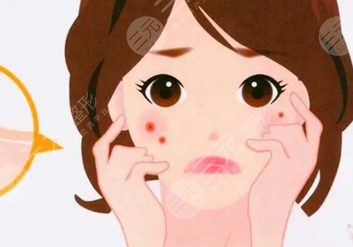 祛痘印小窍门|目前比较有的方法盘点!