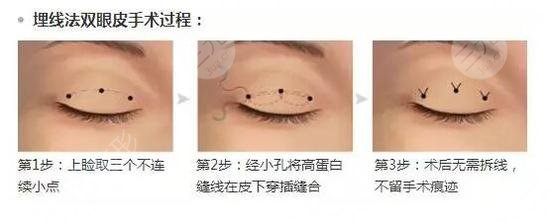 高分子压双眼皮?手术原理
