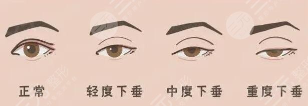 什么是上睑下垂?