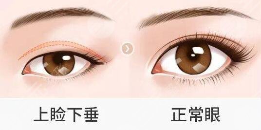 造成上眼睑下垂的原因