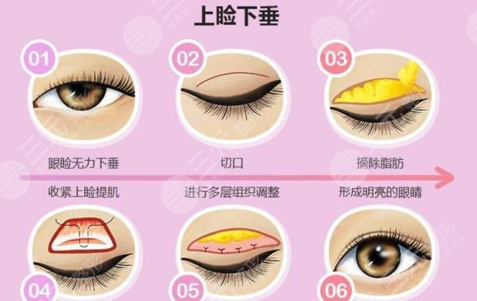 上眼睑下垂恢复锻炼法有用吗?