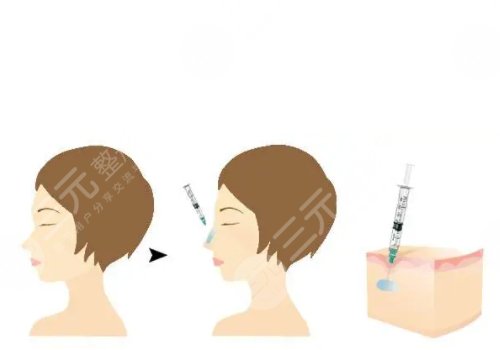 打玻尿酸有什么作用呢?