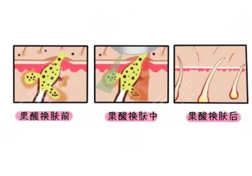 果酸换肤的功有什么?