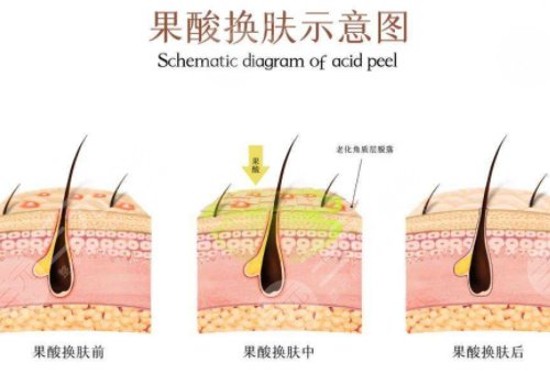 果酸换肤的功有什么?