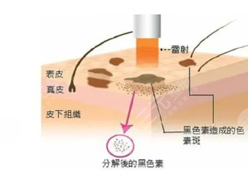 激光祛斑多久能恢复正常皮肤啊?