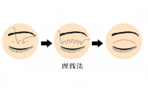 欧式双眼皮可以修复成自然双眼皮吗?