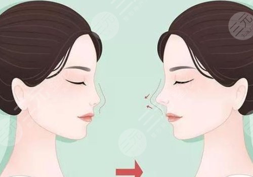耳软骨隆鼻可以维持多久?