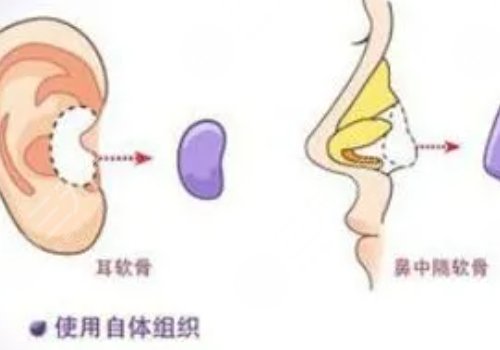 耳软骨隆鼻可以维持多久?