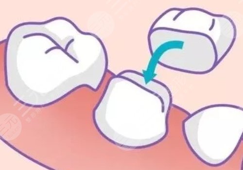 烤瓷牙多少钱一个?