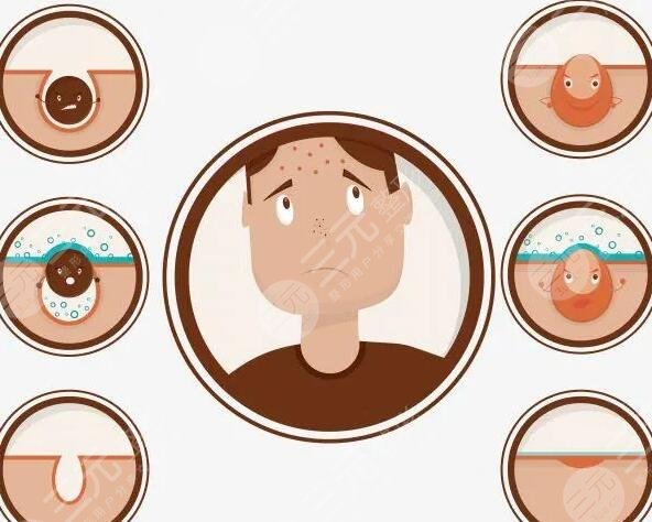 痤疮的治疗方法有哪些?