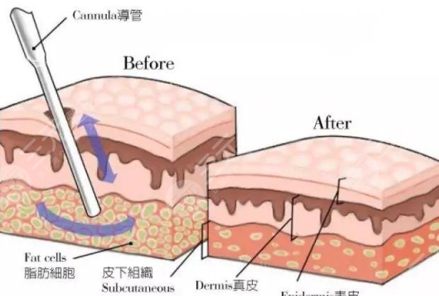 水动力吸脂