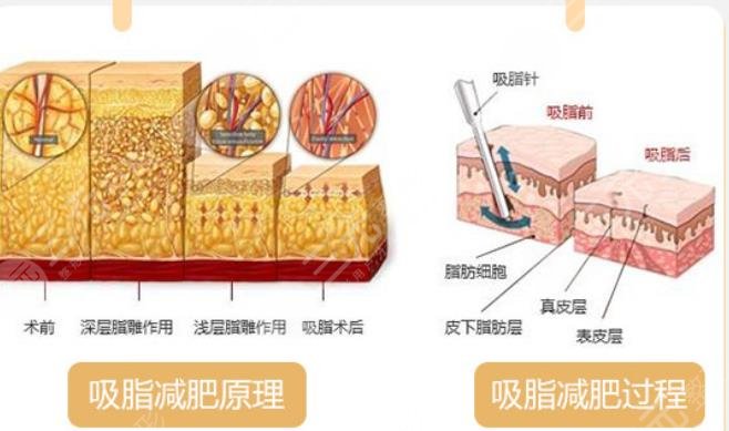 水动力吸脂