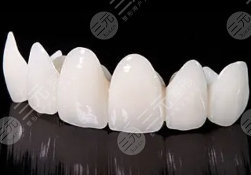 烤瓷牙套掉了(脱落了)怎么办？