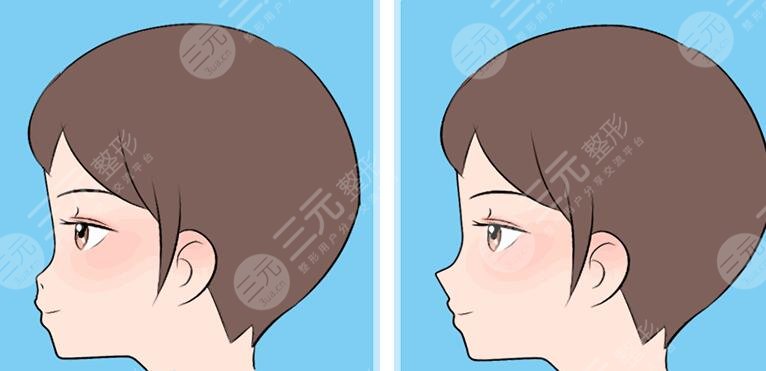 仿生隆鼻使用的什么材料？有没有副作用？带你走进美鼻“黑科技”的前世今生！
