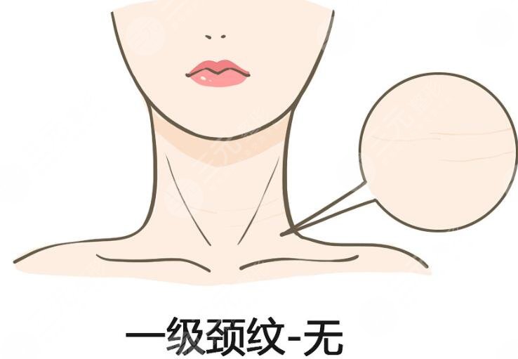 医疗技术祛除颈部皱纹