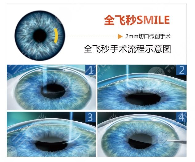 近视眼
