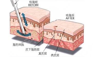 吸脂减肥的原理