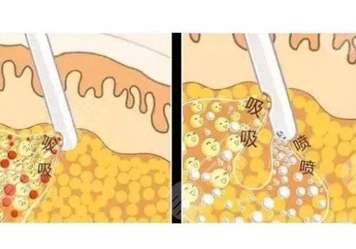 抽脂的风险有多大?果怎么样?