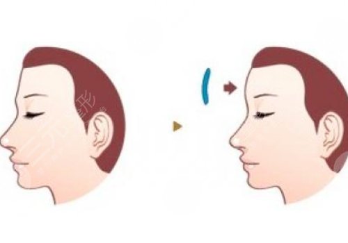 额头窄丰额头要多少钱?