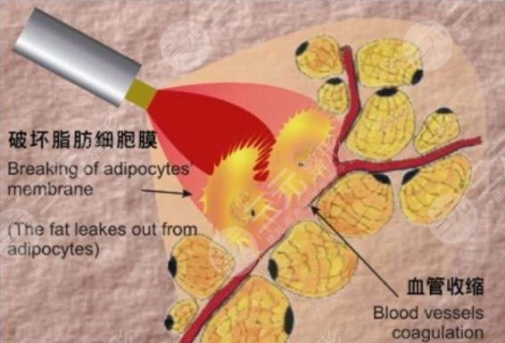 抽脂的危害和副作用有哪些?