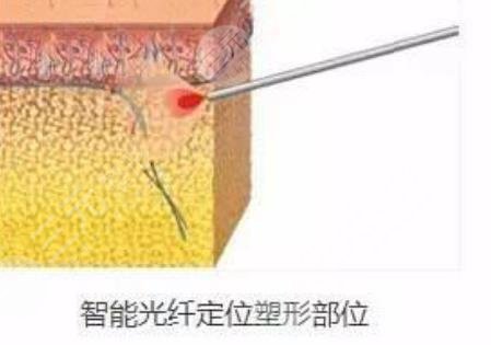 光纤溶脂