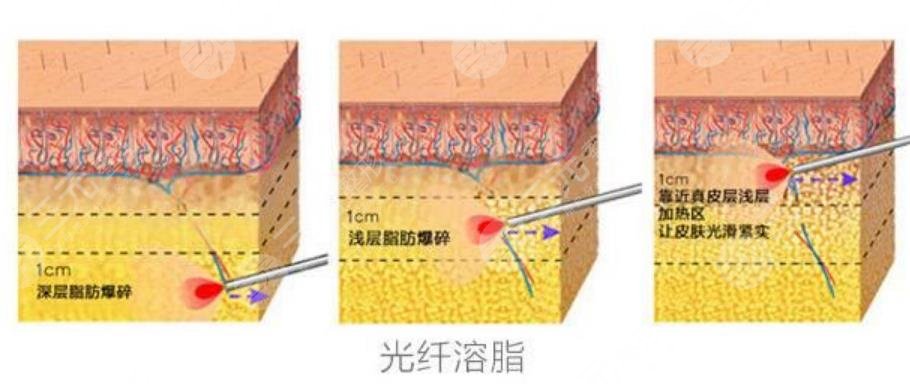 光纤溶脂