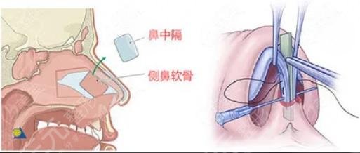 肋软骨隆鼻技术介绍