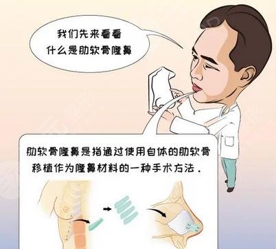 肋软骨隆鼻技术介绍