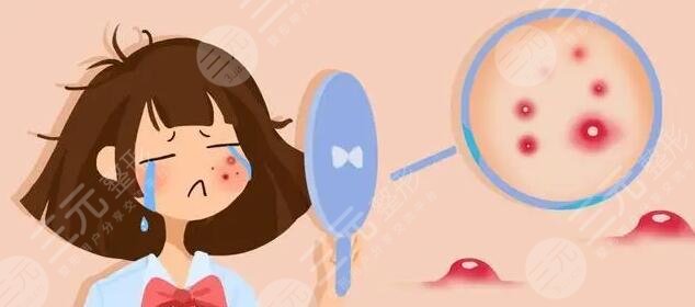 脸上长痘痘的原因
