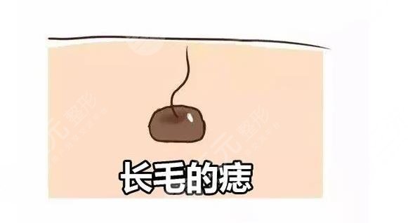 痣上长毛是什么原?因?