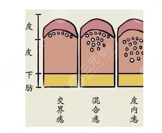 痣上长毛是什么原?因?