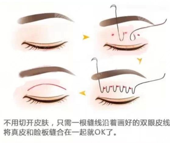 双眼皮