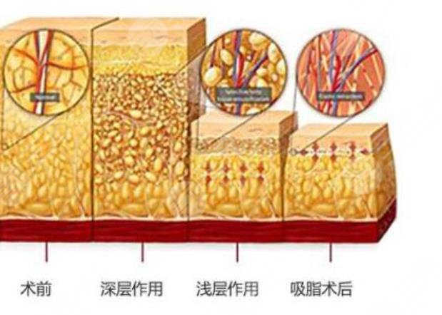 溶脂