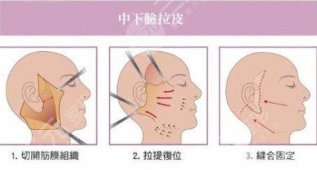 拉皮