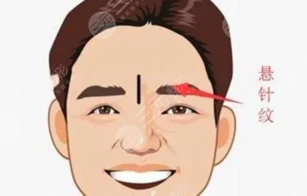 悬针纹