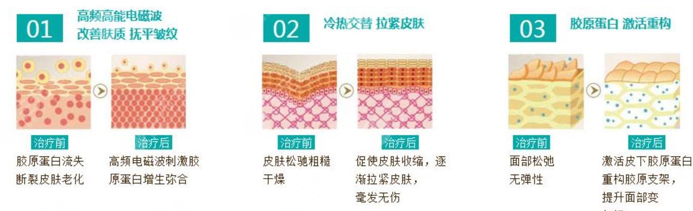 热玛吉