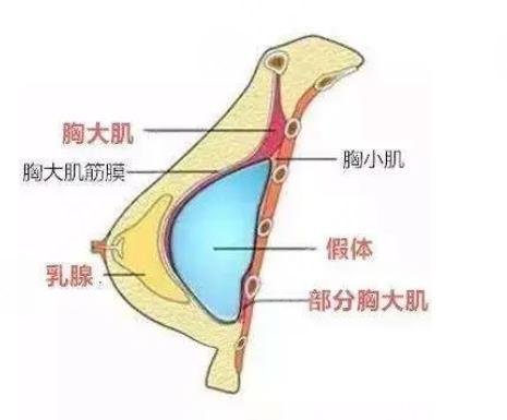 隆胸