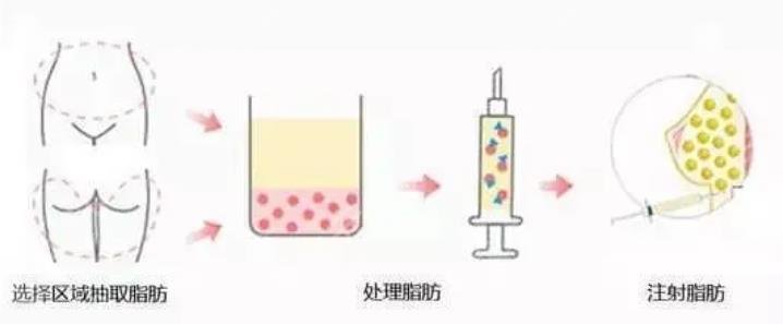 隆胸