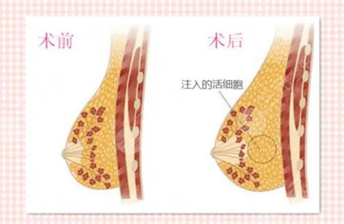 隆胸