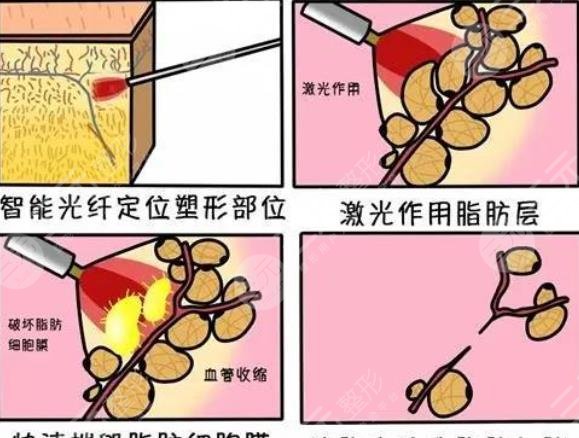 等离子激光溶脂