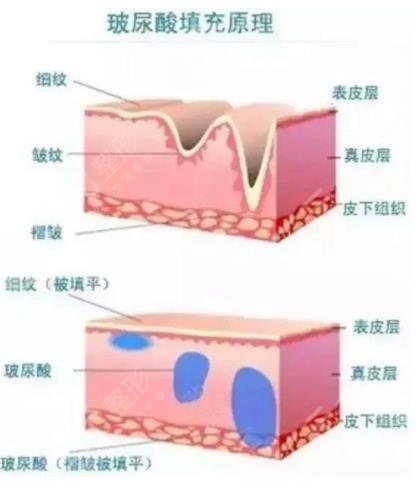 注射玻尿酸