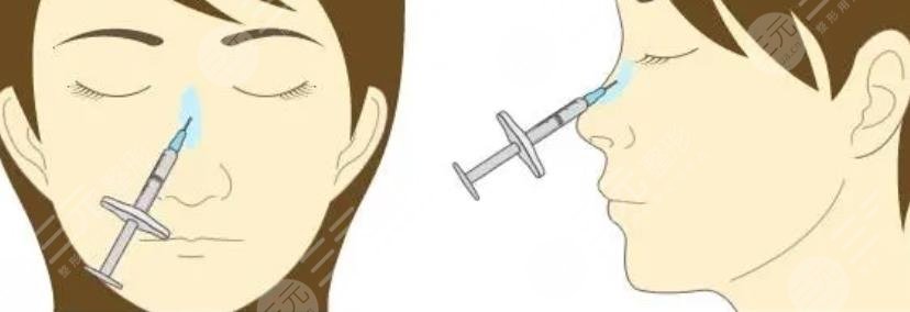 注射隆鼻