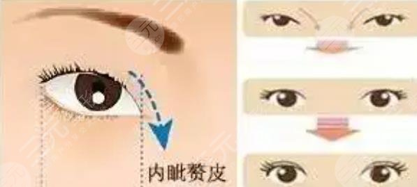 开眼角