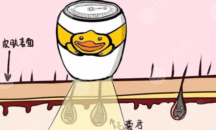 微针