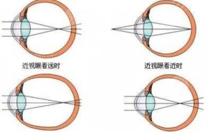近视治疗方式有哪些？去医院做近视眼矫正手术需要注意哪些事情？