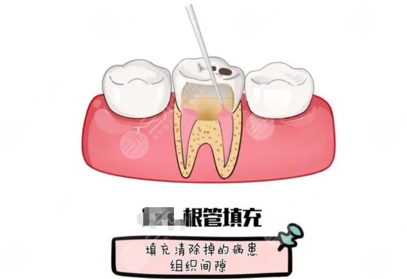 根管治疗一颗牙多少?钱?