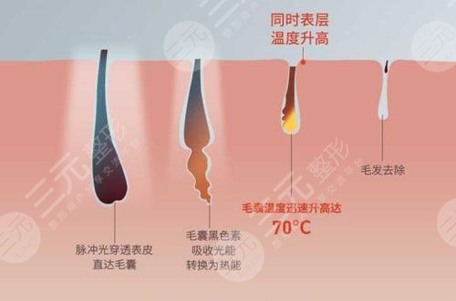 激光脱毛多少钱?