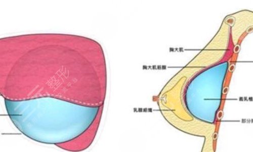 硅胶丰胸好还是自体脂肪丰胸好?